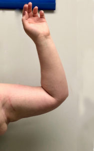 Arm Liposuction Before and After Pictures Buffalo, NY
