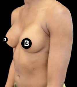 Breast Augmentation Before and After Pictures in Buffalo, NY