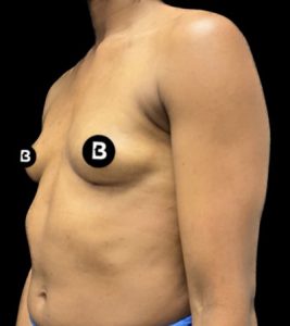 Breast Augmentation Before and After Pictures in Buffalo, NY