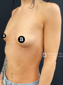 Breast Augmentation Before and After Pictures in Buffalo, NY