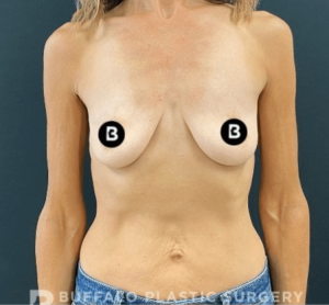 Breast Augmentation Before and After Pictures in Buffalo, NY