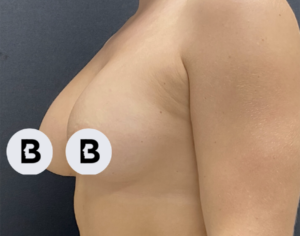 Breast Augmentation Before and After Pictures Buffalo, NY
