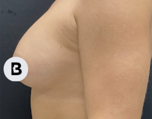 Breast Augmentation Before and After Pictures Buffalo, NY