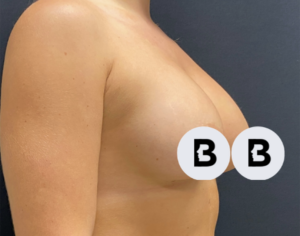 Breast Augmentation Before and After Pictures Buffalo, NY