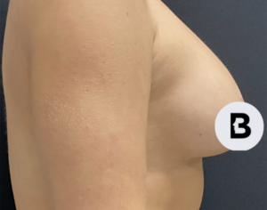 Breast Augmentation Before and After Pictures Buffalo, NY
