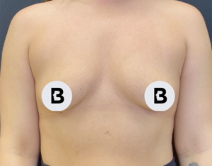 Breast Augmentation Before and After Pictures Buffalo, NY