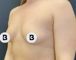 Breast Augmentation Before and After Pictures Buffalo, NY
