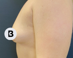 Breast Augmentation Before and After Pictures Buffalo, NY