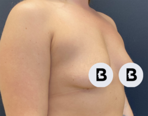 Breast Augmentation Before and After Pictures Buffalo, NY