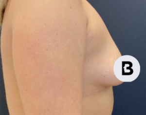 Breast Augmentation Before and After Pictures Buffalo, NY