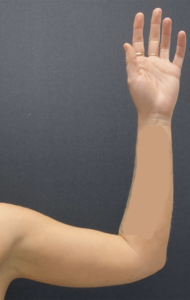 Arm Liposuction Before and After Pictures Buffalo, NY