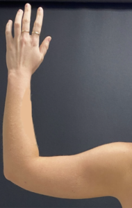 Arm Liposuction Before and After Pictures Buffalo, NY
