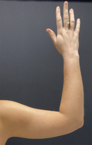 Arm Liposuction Before and After Pictures Buffalo, NY