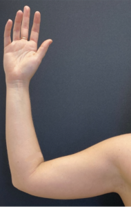 Arm Liposuction Before and After Pictures Buffalo, NY