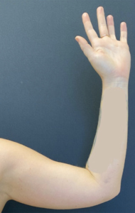 Arm Liposuction Before and After Pictures Buffalo, NY