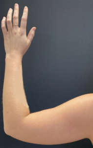 Arm Liposuction Before and After Pictures Buffalo, NY