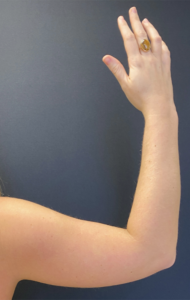 Arm Liposuction Before and After Pictures Buffalo, NY
