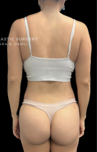 Brazilian Butt Lift Before and After Pictures in Buffalo, NY