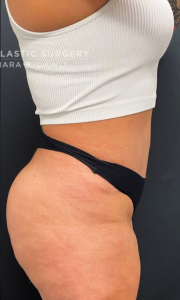 Brazilian Butt Lift Before and After Pictures in Buffalo, NY