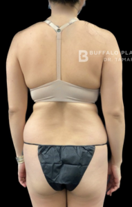 Brazilian Butt Lift Before and After Pictures in Buffalo, NY