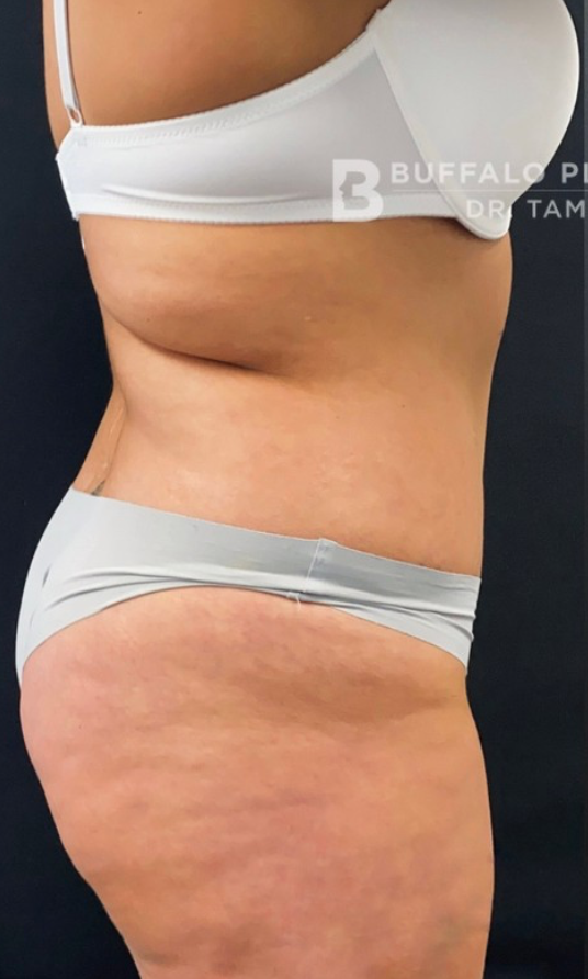 Brazilian Butt Lift Before and After Pictures in Buffalo, NY
