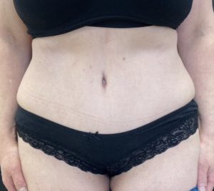 Abdominoplasty (Tummy Tuck) Before and After Pictures Buffalo, NY