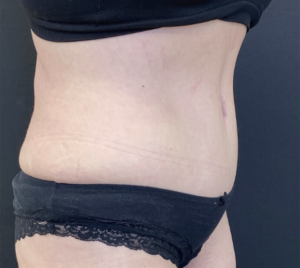 Abdominoplasty (Tummy Tuck) Before and After Pictures Buffalo, NY