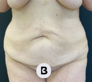 Abdominoplasty (Tummy Tuck) Before and After Pictures Buffalo, NY