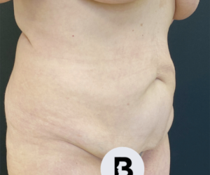 Abdominoplasty (Tummy Tuck) Before and After Pictures Buffalo, NY