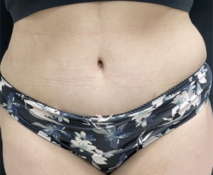 Abdominoplasty (Tummy Tuck) Before and After Pictures Buffalo, NY
