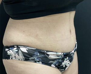 Abdominoplasty (Tummy Tuck) Before and After Pictures Buffalo, NY