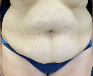 Abdominoplasty (Tummy Tuck) Before and After Pictures Buffalo, NY
