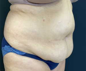 Abdominoplasty (Tummy Tuck) Before and After Pictures Buffalo, NY