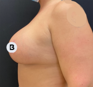 Breast Augmentation Before and After Pictures Buffalo, NY