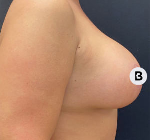 Breast Augmentation Before and After Pictures Buffalo, NY