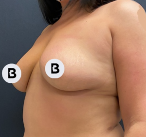 Breast Augmentation Before and After Pictures Buffalo, NY