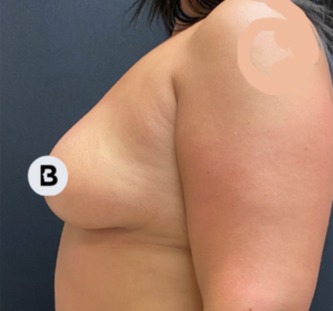 Mastopexy (Breast Lift) Before and After Pictures in Buffalo, NY