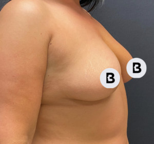Breast Augmentation Before and After Pictures Buffalo, NY