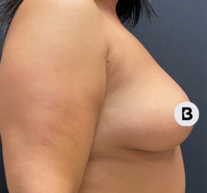 Mastopexy (Breast Lift) Before and After Pictures in Buffalo, NY