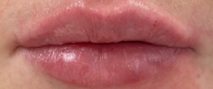 Lip Fillers Before and After Pictures Buffalo, NY
