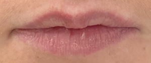 Lip Fillers Before and After Pictures Buffalo, NY