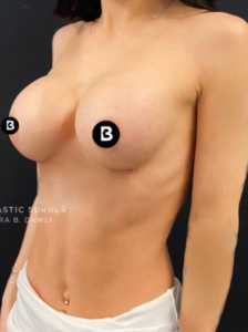 Breast Augmentation Before and After Pictures in Buffalo, NY