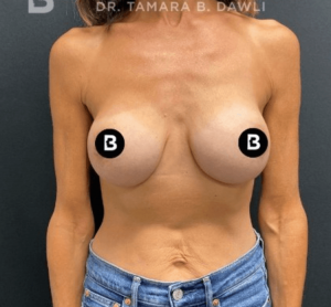 Breast Augmentation Before and After Pictures in Buffalo, NY