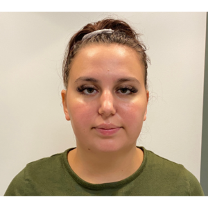 Chin Liposuction Before and After Pictures Buffalo, NY