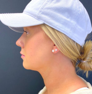 Chin Fillers Before and After Pictures Buffalo, NY