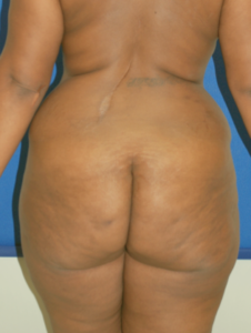 Brazilian Butt Lift Before and After Pictures Buffalo, NY