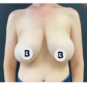 Mastopexy (Breast Lift) Before and After Pictures Buffalo, NY