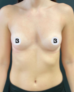 Breast Augmentation Before and After Pictures Buffalo, NY