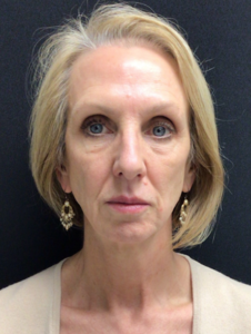 Facelift Before and After Pictures in Buffalo, NY
