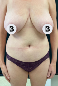Liposuction Before and After Pictures in Buffalo, NY